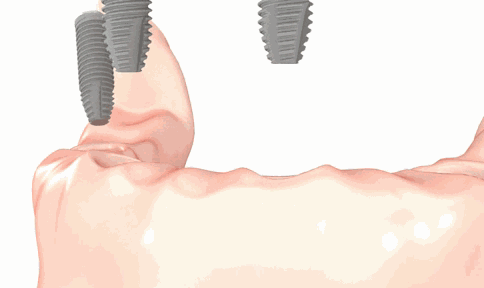 全口缺牙种植几颗_All-on-4种植牙技术科普_做全口种植要多少钱