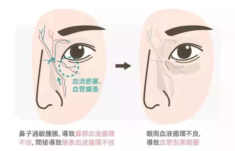 孩子有黑眼圈是怎么办_眼部肌肤衰老原因_黑眼圈成因及解决方法